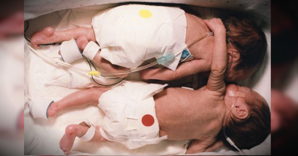 20 Years Ago, These Twins Made History With A Miracle Hug -- WOW!